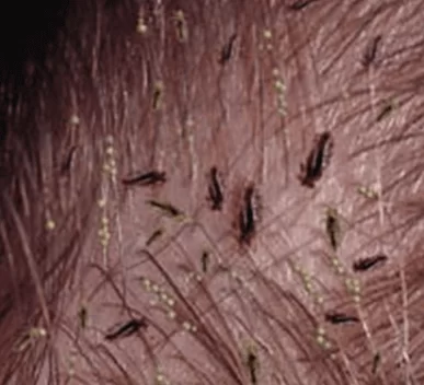 Vegan Mom Refuses to Kill Lice in Daughter’s Hair
